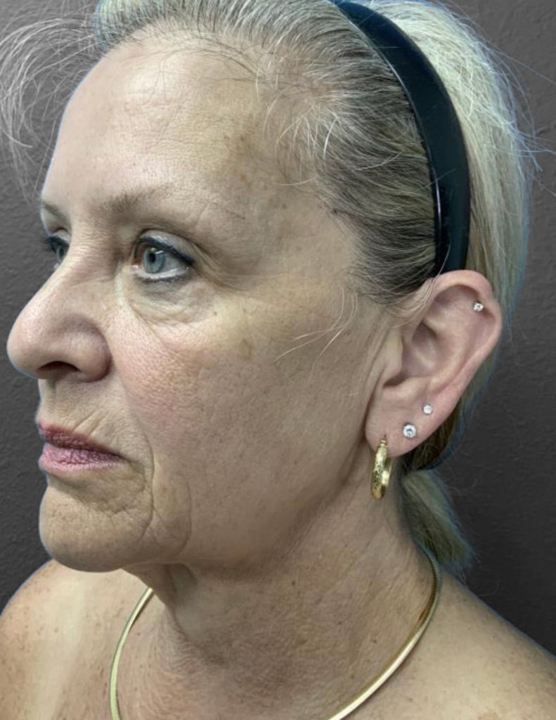 Profile view of mature woman showcasing subtle cosmetic enhancements.