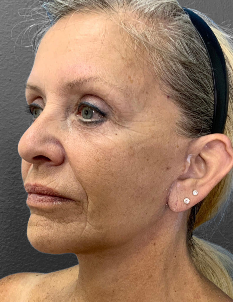 Patient profile showcasing natural results of Lentz Plastic Surgery procedures.