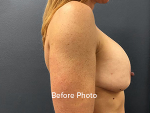 Before photo showcasing breast augmentation results at Lentz Plastic Surgery.