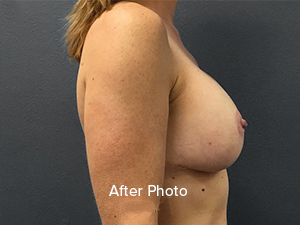 Breast augmentation after photo showcasing enhanced profile and natural appearance.