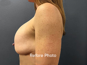 Before photo showcasing side profile of breast enhancement candidate.