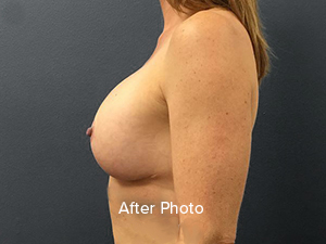 Breast augmentation after photo showcasing natural results by Lentz Plastic Surgery.