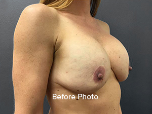 Before photo of breast augmentation patient at Lentz Plastic Surgery.