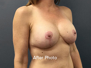 Breast augmentation after photo showcasing natural results by Lentz Plastic Surgery.