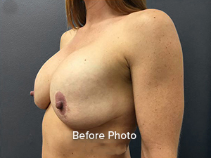 Before photo of breast augmentation patient, highlighting natural contours.