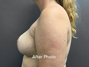 Breast augmentation after photo showcasing natural results and professional care.
