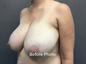 Before photo of breast augmentation patient at Lentz Plastic Surgery.