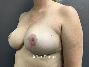 Post-surgery breast enhancement result showcasing natural contours.