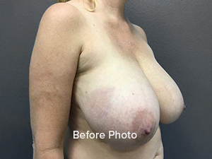 Before photo of breast augmentation patient at Lentz Plastic Surgery.