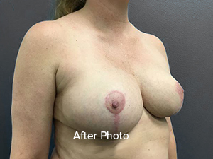Breast augmentation after photo showcasing natural results at Lentz Plastic Surgery.