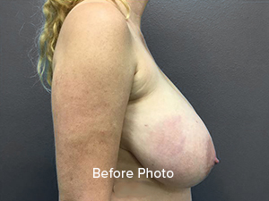 Before breast surgery consultation, highlighting patient profile and concerns.