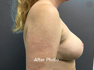 Post-surgery profile view highlighting breast enhancement results.