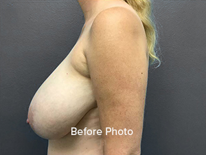 Before photo of breast augmentation patient, showcasing profile and skin tone.