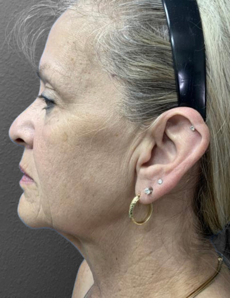 Profile view of a woman showcasing elegant earrings, highlighting facial aesthetics.