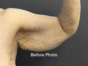 Before photo showcasing arm contouring results at Lentz Plastic Surgery.