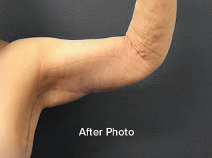 Post-surgery arm transformation showcasing improved contour and skin texture.