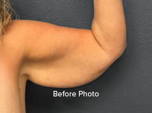 Before photo of arm showcasing skin texture and contour for Lentz Plastic Surgery.