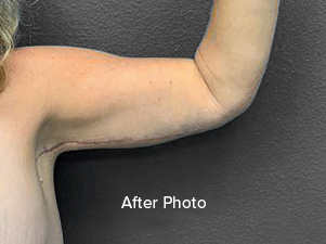 After photo showcasing improved arm contour from Lentz Plastic Surgery.