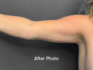 Post-surgery arm transformation showcasing smooth, toned results.