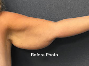 Before photo of arm highlighting areas for cosmetic improvement.