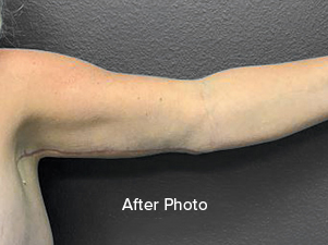 Arm after cosmetic surgery, showcasing smooth skin and refined contours.