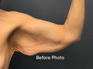 Before photo of arm showcasing skin texture and contour for Lentz Plastic Surgery.