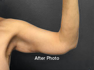 After photo showcasing toned arm post-surgery at Lentz Plastic Surgery.