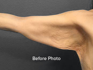 Before photo of arm showing skin texture and laxity, highlighting surgical need.