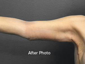 After photo of a smooth, toned arm post-surgery at Lentz Plastic Surgery.