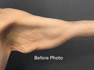 Before photo of arm showcasing skin texture and contour for Lentz Plastic Surgery.