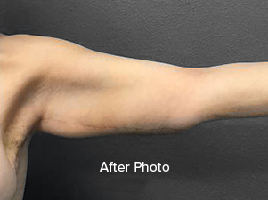 After photo showcasing toned arm post-surgery at Lentz Plastic Surgery.