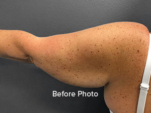 Before photo of arm showcasing skin texture and tone, highlighting surgical potential.