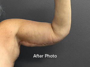 Post-surgery arm transformation showcasing improved contour and skin texture.