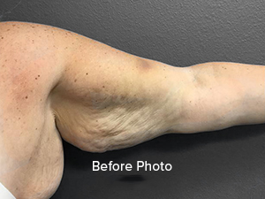 Before photo of arm highlighting skin texture and laxity issues.