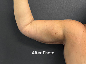 After photo showcasing toned arm post Lentz Plastic Surgery procedure.