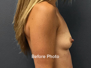 Before photo showcasing a side view of a woman's torso for plastic surgery consultation.