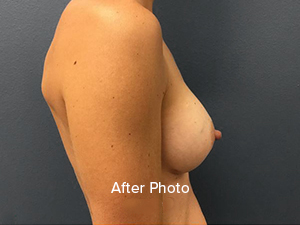 Breast augmentation after photo showcasing natural results at Lentz Plastic Surgery.
