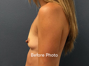 Before photo showcasing a side profile of a woman, highlighting breast aesthetics.
