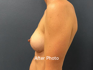Breast augmentation after photo showcasing natural results and professional care.
