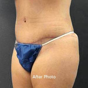 Post-surgery body contouring results highlighting improved silhouette.