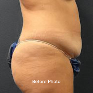 Before photo showcasing abdominal area, highlighting potential for cosmetic improvement.