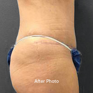 Post-surgery body contouring result showcasing improved silhouette.