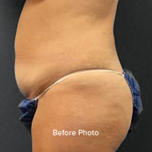 Before photo showcasing body contouring results at Lentz Plastic Surgery.