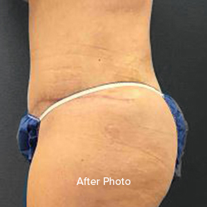 Post-surgery body contouring results highlighting smooth skin.