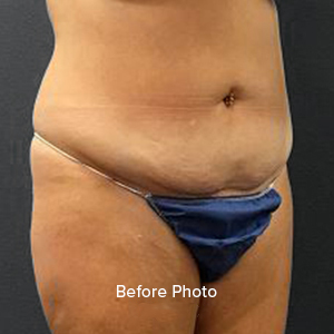 Before photo showcasing abdominal area, highlighting skin texture and contour.