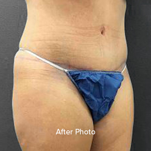 Post-surgery body contouring result, showcasing improved abdominal appearance.