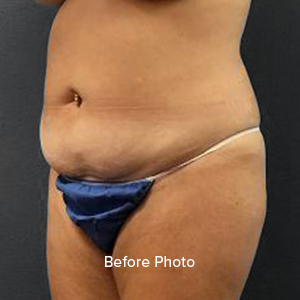 Before photo showcasing abdominal contouring results at Lentz Plastic Surgery.