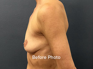 Before photo showcasing side profile of breast enhancement candidate.