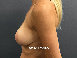 Breast augmentation after photo showcasing natural results at Lentz Plastic Surgery.
