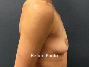 Before photo showcasing breast augmentation results at Lentz Plastic Surgery.